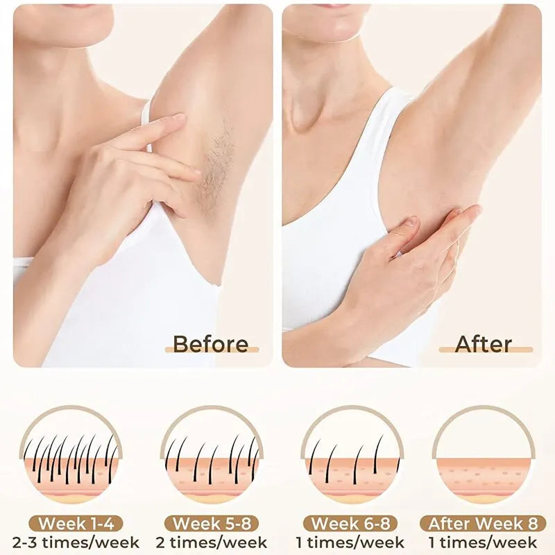 Depiladora Láser IPL Profesional de Luz Pulsada 3 en 1